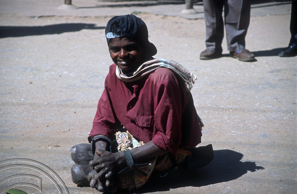 T5878. Young boy with leprosy. Sravanabelagola. Karnataka. India. January 1996